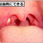 膿栓