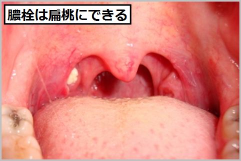 膿栓の取り方はのどの奥のうがい