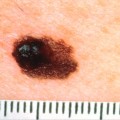 悪性黒色腫に画期的な新薬が登場