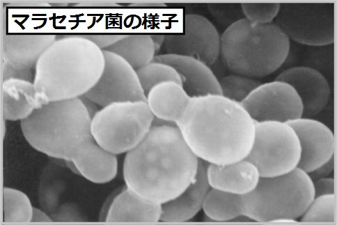 マラセチア毛包炎はマラセチア菌が原因