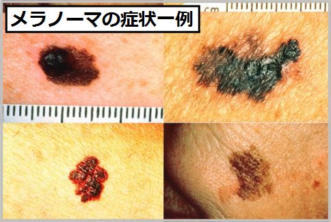 メラノーマの症状の見分け方