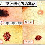 ダーモスコピーでメラノーマを見分ける