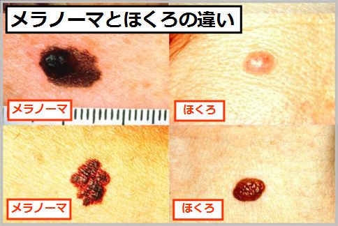 メラノーマの症状の見分け方