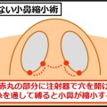 小鼻縮小術はメスを入れずにたった30分で完了
