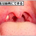 臭い玉は扁桃にできる
