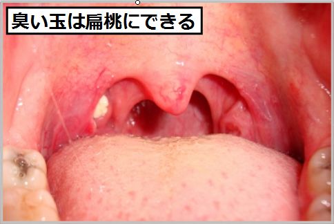 臭い玉は扁桃にできる