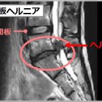 椎間板ヘルニア