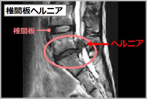 椎間板ヘルニアとは